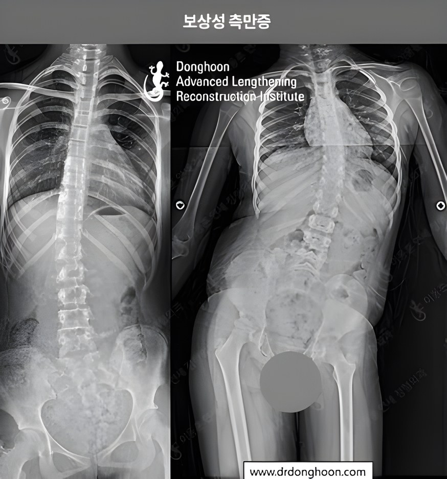 하지부동으로 인해 골반이 기울어진 상태에서 몸을 바로 세우기 위해서는 척추를 인위적으로 휘어야 하는 ‘보상성 측만증’이 발생합니다.