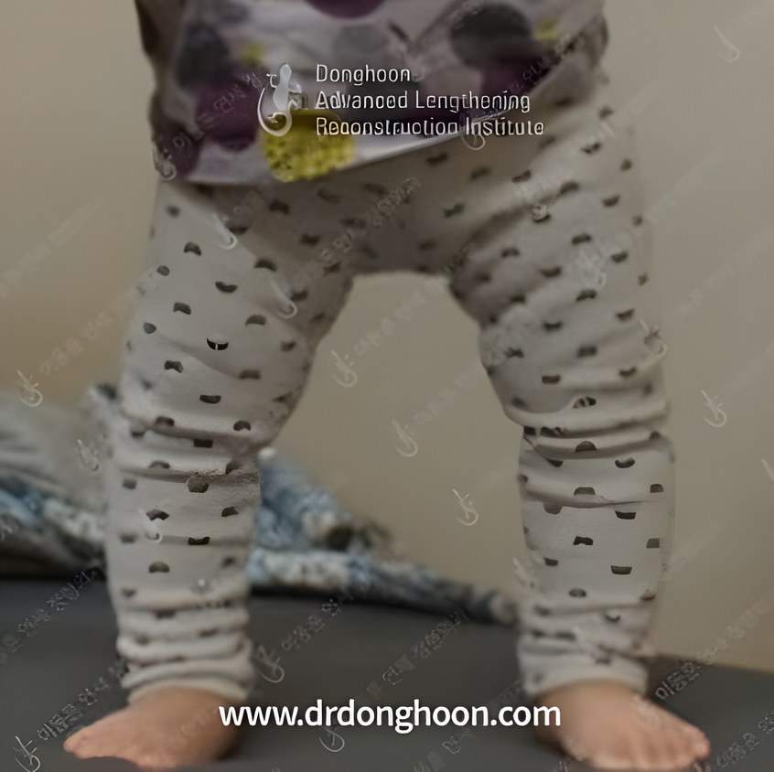 흔히 보는 정상적인 소아 오다리