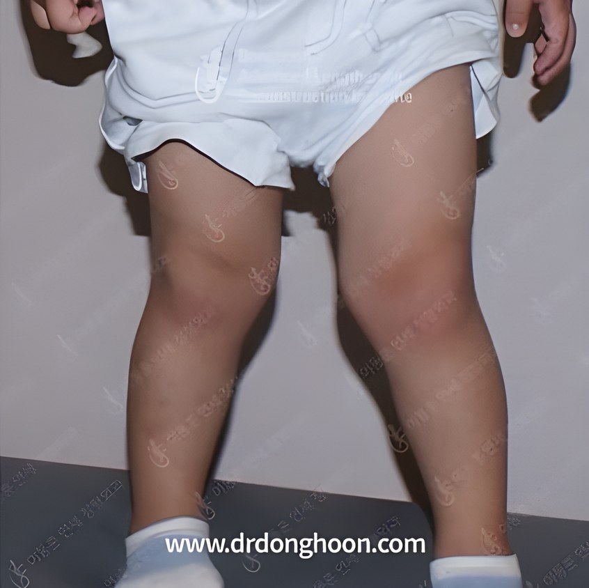 흔히 보는 정상적인 소아 엑스다리