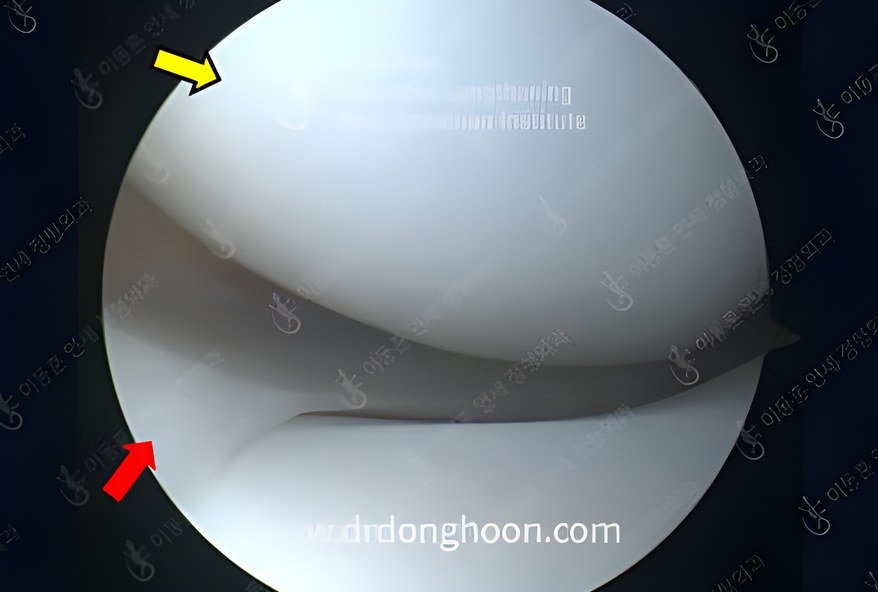 정상 관절의 모습 대퇴골의 연골 (노란색 화살표) 과 정상 반월상 연골 (붉은색 화살표)
