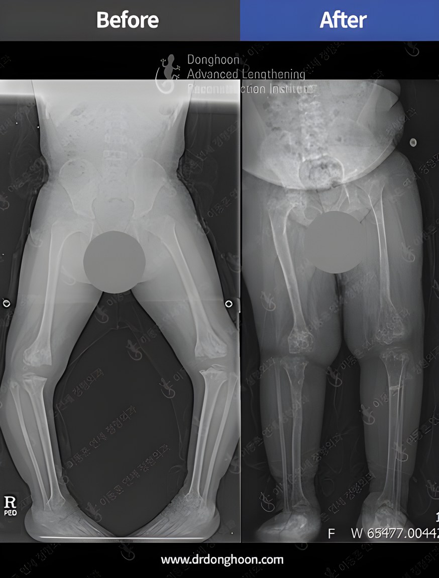 골이형성증 (epiphyseal dysplasia)으로 인한 소아 휜다리의 치료