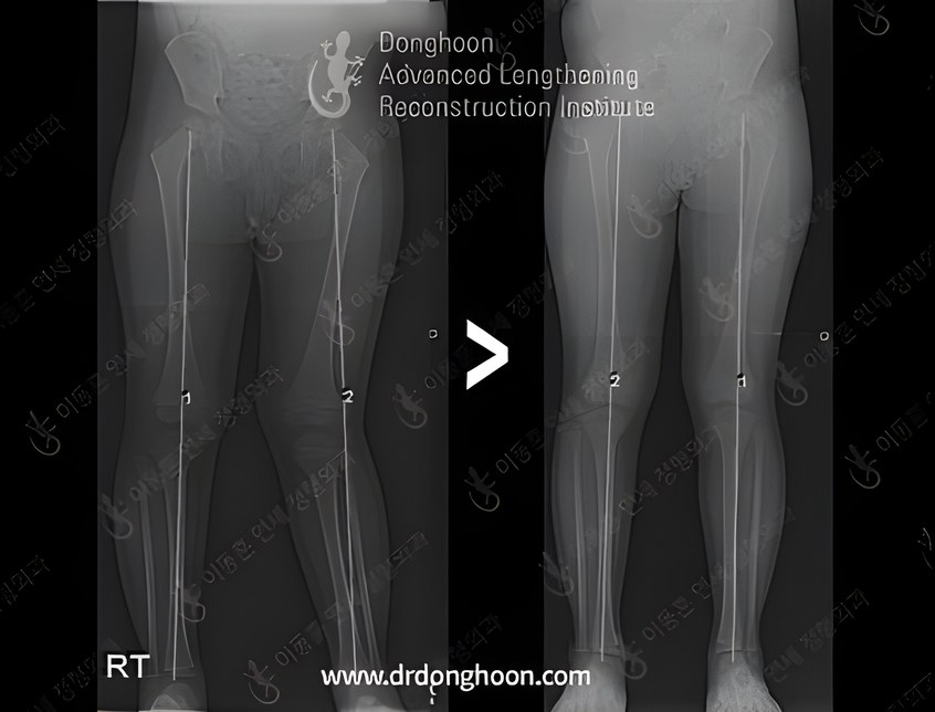 소아 엑스다리가 아무 치료없이 저절로 교정되는 과정